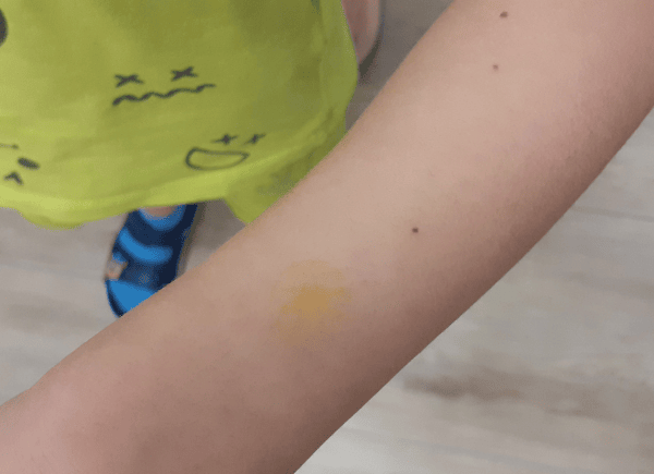 Pieczątka "słoneczko" na ręku dziecka